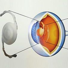 Lentes Intraoculares